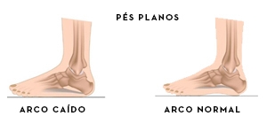 Pés planos | Andar descalço na caminhada ou corrida | Holmes Place