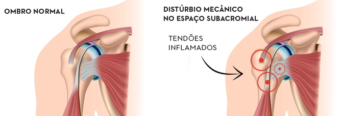 fiisoterapia dor no ombro_texto
